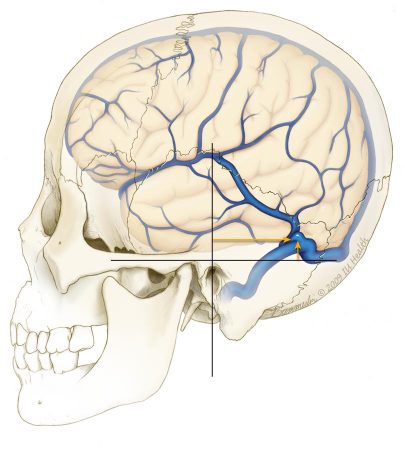 Brain and vein of Labbe within skull